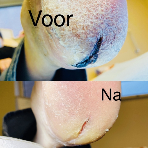 Diabetespatienten